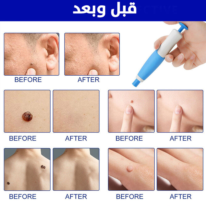 قلم إزالة الثالولة من الجسم والوجه tag removal kit  أدوات صحية