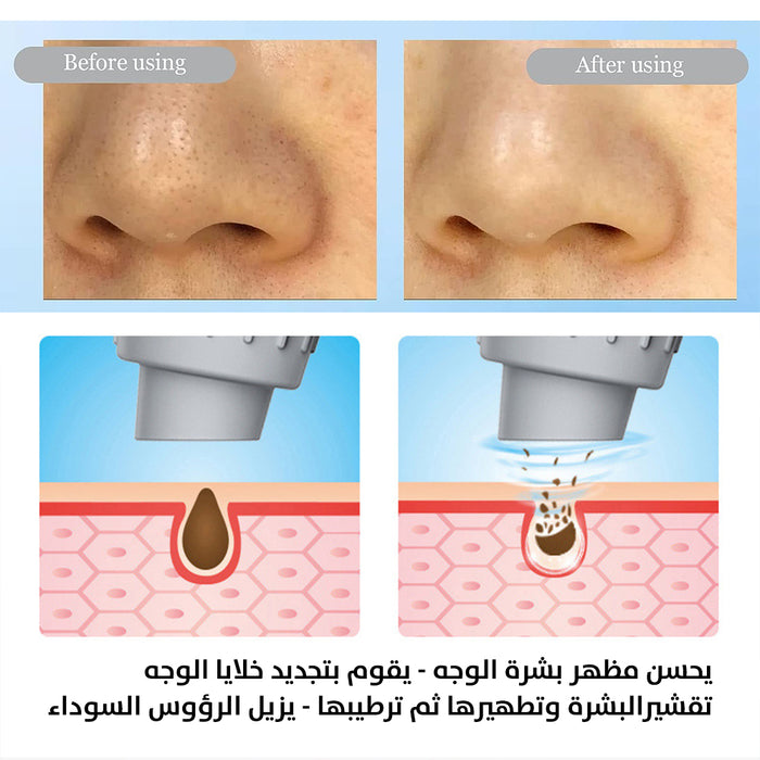 جهاز الهيدرافيشل المنزلي المميز ماركة فيتال الايطالية vital HydraFacial blackheads remover VIT-011  مستلزمات نسائية