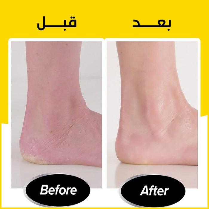 مزيل الجلد الميت مـن القدمين يعمل بالشحن Callus Remover for Feet  مستلزمات صحية