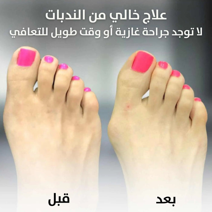 مصحح لأصابع القدم Bunion Corrector Relief Orthopedic Splint -  