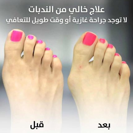مصحح لأصابع القدم Bunion Corrector Relief Orthopedic Splint 1766
