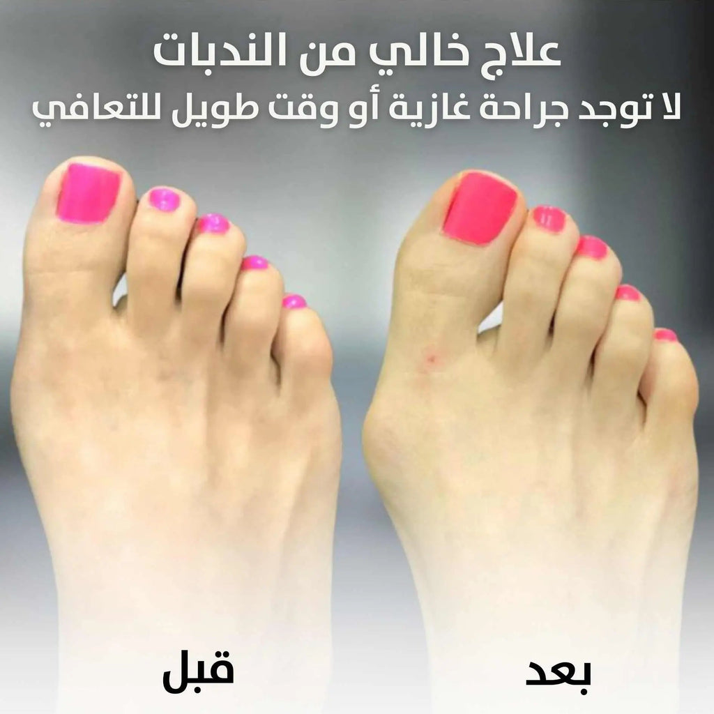 مصحح لأصابع القدم Bunion Corrector Relief Orthopedic Splint 1766